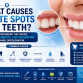 What Causes White Spots on Teeth? Understanding the Reasons and Treatment