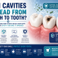 How Can Cavities Spread from Tooth to Tooth? The Truth About Tooth Decay