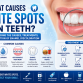 What Causes White Spots on Teeth? Causes, Treatments, and Prevention