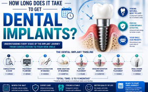 How Long Does It Take to Get Dental Implants?