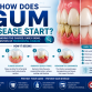 How Does Gum Disease Start? Causes, Early Signs, and Prevention