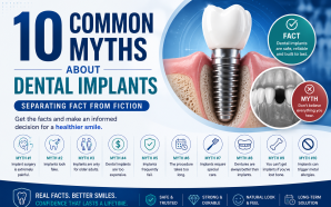 10 Common Myths About Dental Implants Debunked