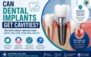 Can Dental Implants Get Cavities?